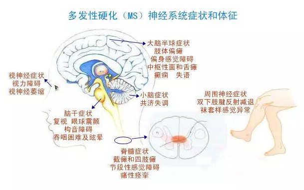 多发性硬化，最新疗法的探索与展望